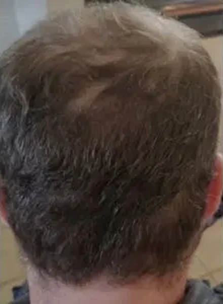 ProCell microchanneling hair regrowth before and after at Ezina Beauty in Blaine, MN: after