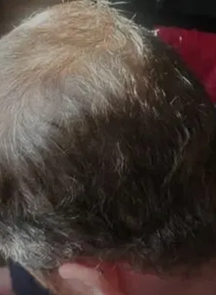 ProCell microchanneling hair regrowth before and after at Ezina Beauty in Blaine, MN: before
