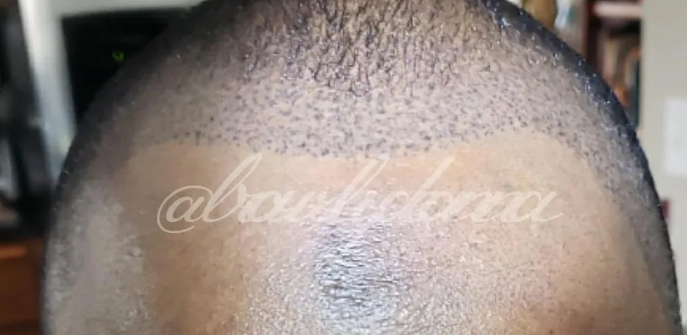 Scalp micropigmentation hairline