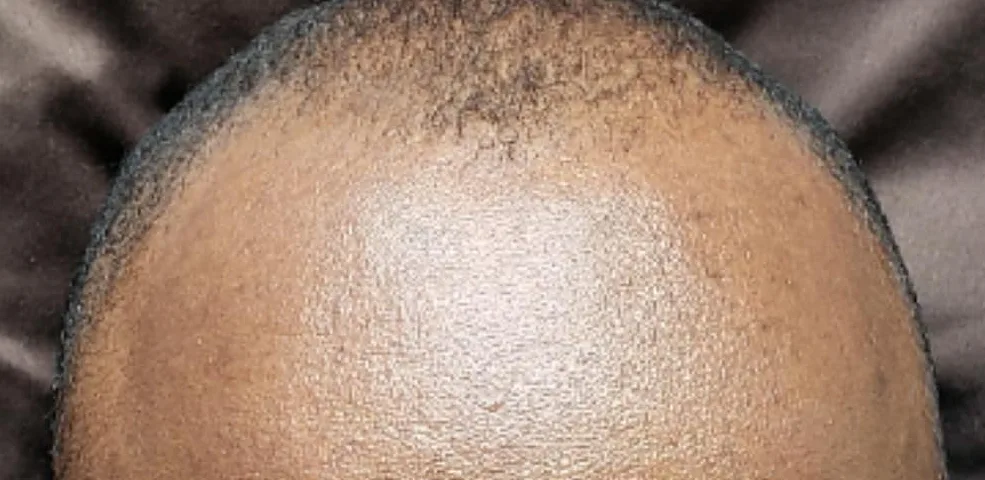 Scalp micropigmentation hairline before and after: before